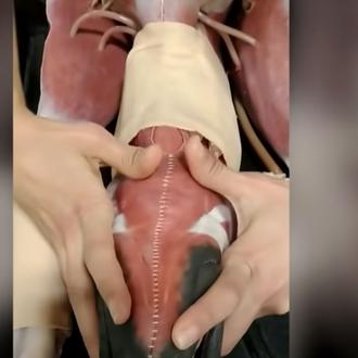 La Técnica de Extracción Externa: muy útil para salvar a …
